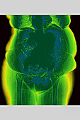 Obesity, X-ray