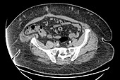 Obesity, CT scan