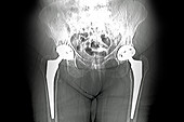 Total hip prostheses, X-ray