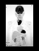 Anaplastic Carcinoma of Thyroid Gland, PET