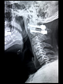 Post-operative Fixation of Cervical Spine, X-ray