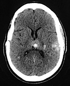 Cavernous Malformations of the Head, CT Scan