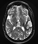 Imaging of Multiple Cavernous Malformations, T2 MR