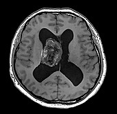 Central Neurocytoma, MRI
