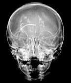 Neonatal CMV Infection, Skull X-ray