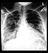 Chest X-ray of Multiple Lung Masses