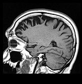 Frontal Temporal Dementia, MRI