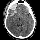 Traumatic Brain Injury, CT