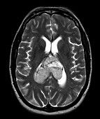 Glioblastoma, MRI