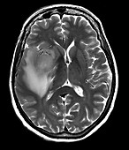 Temporal Glioblastoma, MRI