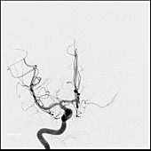Anterior Communicating Artery Aneurysm, Angiogram