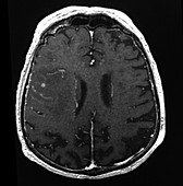 High Grade Glioma, MRI