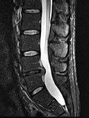 Lumbar Disc Herniation, MRI