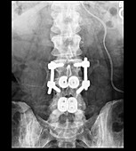 Lumbar Spinal Instrumentation, X-ray