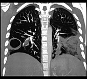 Pneumonia and Lung Abscess, CT