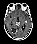 Metastatic Lung Cancer to Brain, MRI