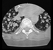 Metastatic Disease to Lungs, CT
