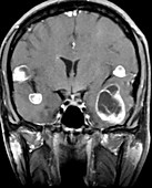 Melanoma Metastatic to Brain, MRI