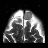 Frontal Meningioma with Path, MRI