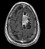 Cystic Meningioma, MRI