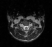 Neurofibromatosis Type 1, MRI
