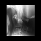 Old Non-union Type II Odontoid Fracture, X-ray