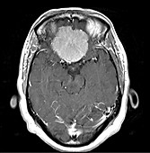 Olfactory Groove Meningioma, MRI