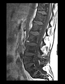 Metastatic Prostate Cancer to Lumbar Spine, MRI