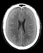 Bilateral Subdural Hematomas, MRI