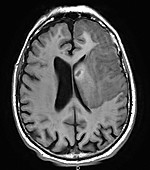 Haemorrhagic Stroke, MRI
