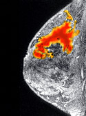 Breast Cancer, MRI