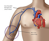 PICC intravenous device, illustration