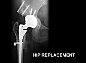 Hip Replacement, X-Ray