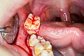 Wisdom tooth extraction