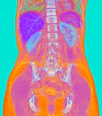 Abdomen and pelvis, coronal MRI scan