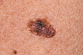 Melanoma in situ