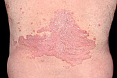 Psoriasis on the lower back