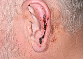 Injury to the ear after an assault