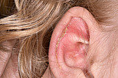 Impetigo infection on ear