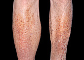 Cellulitis on swollen calf