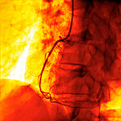 Coronary angiogram stenosed artery