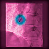 Stent to treat a blockage of the coronary arteries