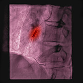 Stent to treat a blockage of the coronary arteries