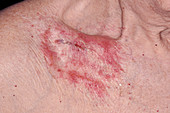 Allergic rash following surgery