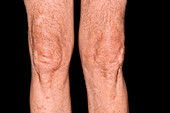 Post-operative arthritis of the knee