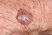 Malignant melanoma