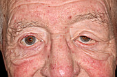 Granular cell tumour affecting the eye