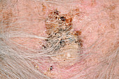 Squamous cell carcinoma