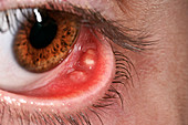 Chalazion abscess on an eyelid