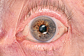 Conjunctival scar from eye injury